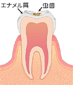 C１：エナメル質の虫歯