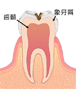 C２：象牙質に達する虫歯