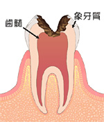 C３：歯髄に達する虫歯