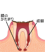 C４：歯根に達する虫歯